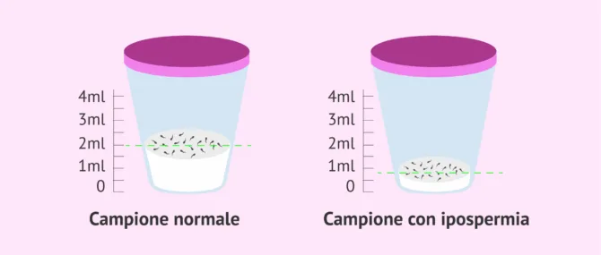 Ipospermia: scarsa eiaculazione di sperma nell'uomo