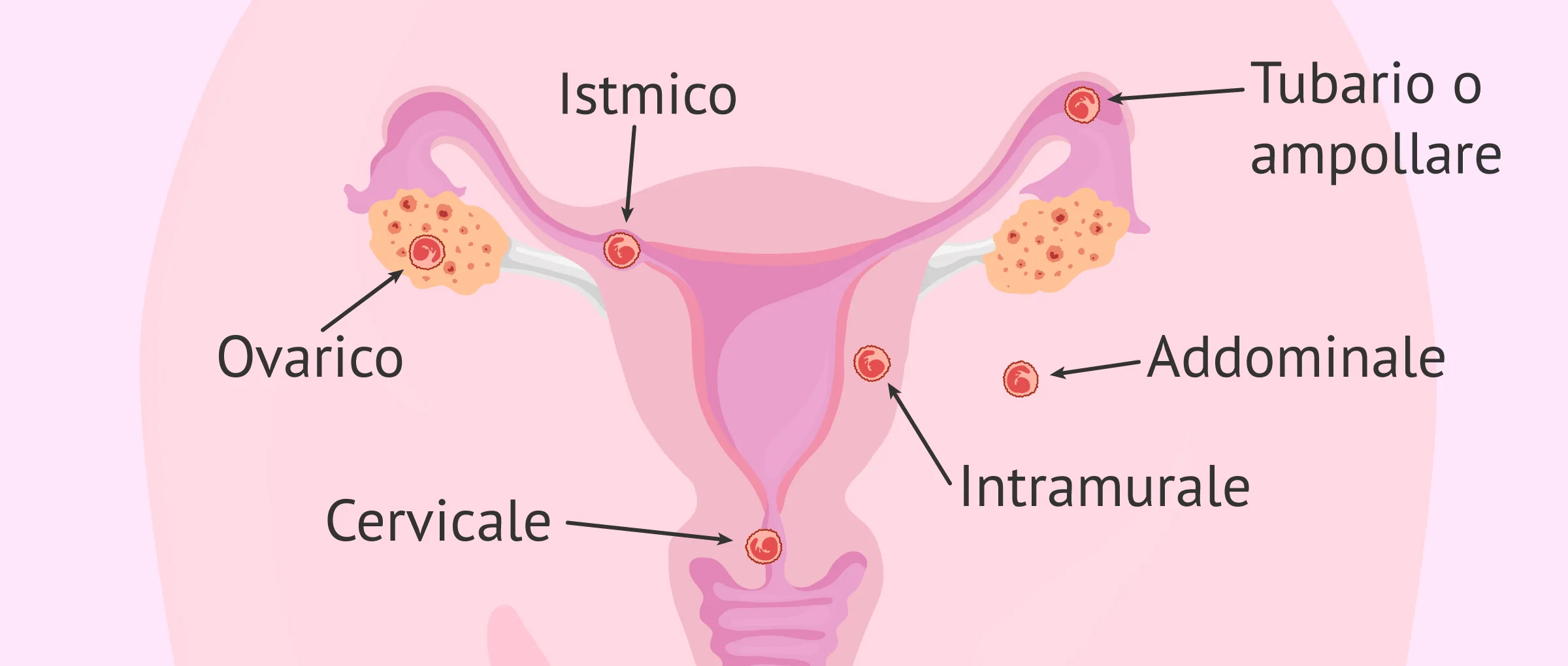 La gravidanza ectopica