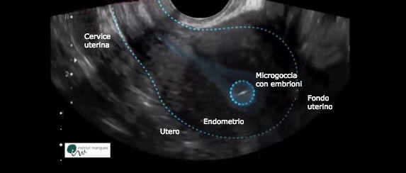 Microgoccia di embrioni sul fondo uterino