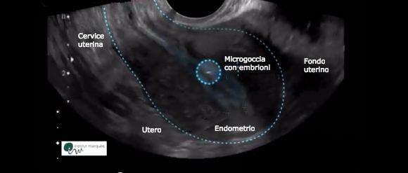 La microgoccia con gli embrioni si dirige verso il fondo