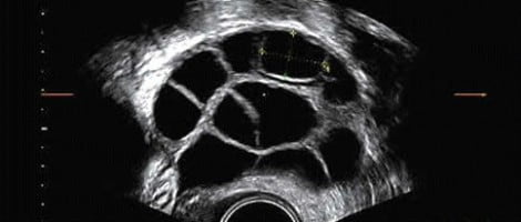 Follicoli antrali nella stimolazione