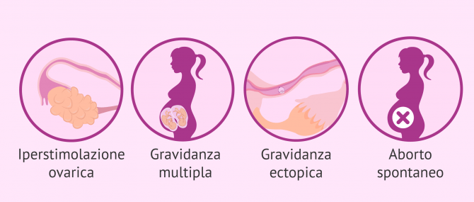 Imagen: Svantaggi dell'inseminazione artificiale: gestazione multipla.