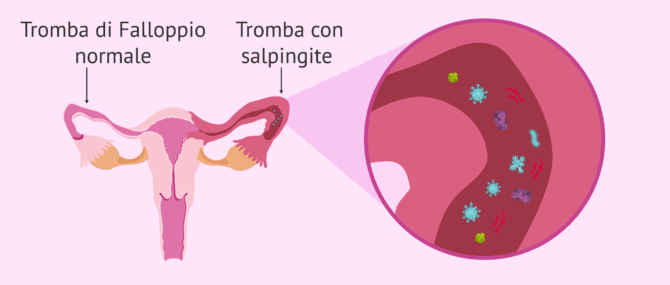 Imagen: Salpingite unilaterale