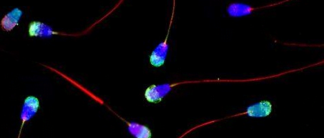 Spermatozoi apoptici presenti nell'eiaculato
