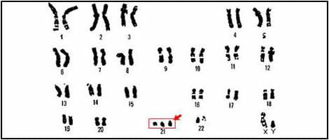 Trisomia 21