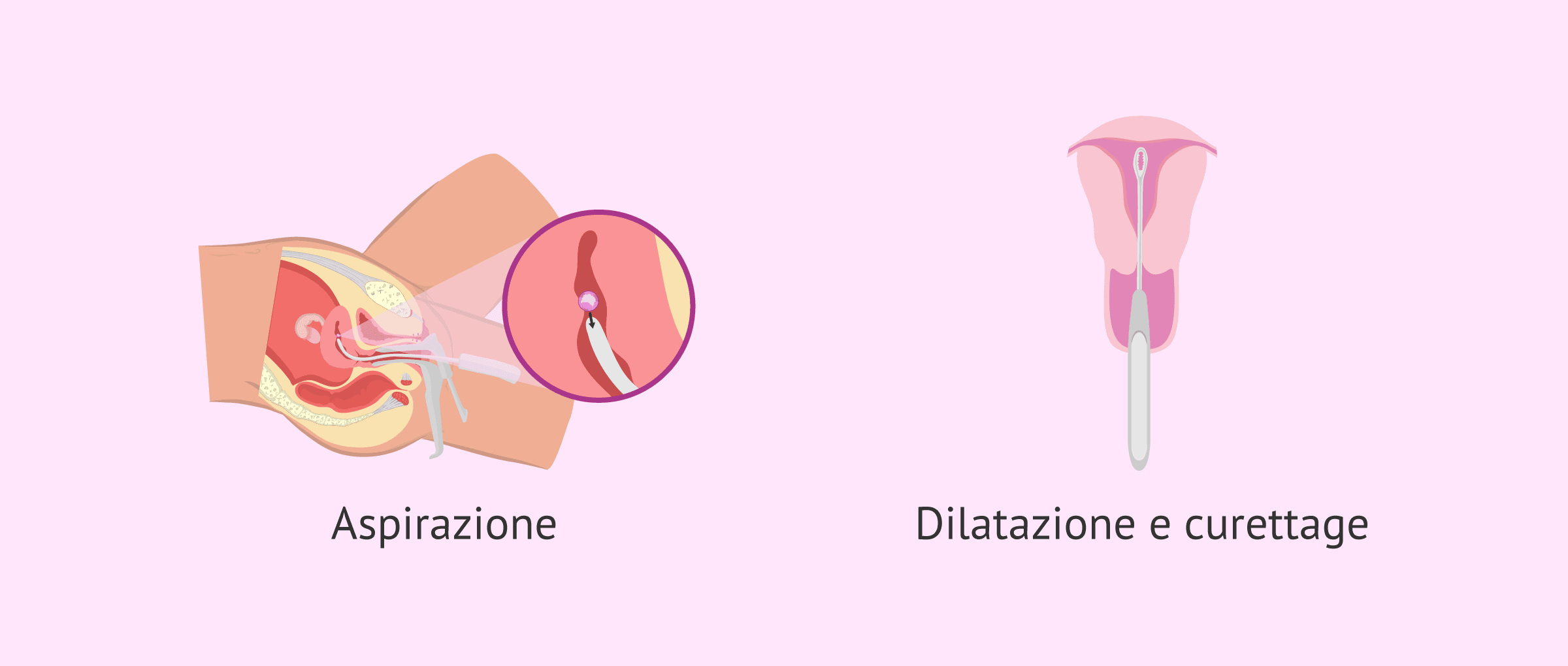 Imagen: Metodi per un aborto chirurgico