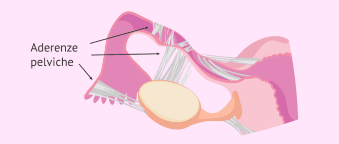 Imagen: Aderenze pelviche