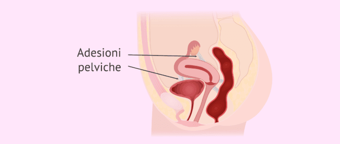 Imagen: Aderenze pelviche nella donna