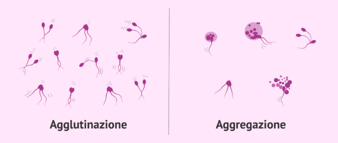 Imagen: Differenza tra agglutinazione spermatica e aggregazione