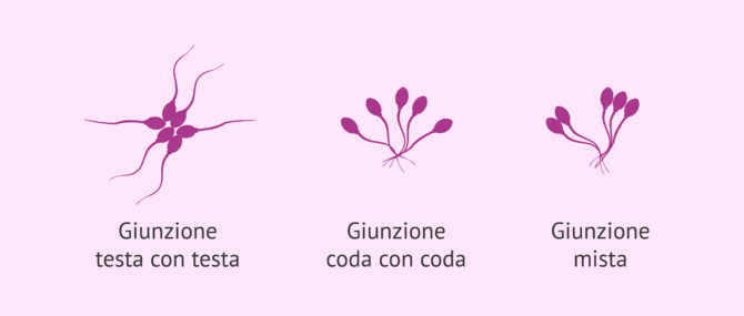 Imagen: Tipi di agglutinazione degli spermatozoi