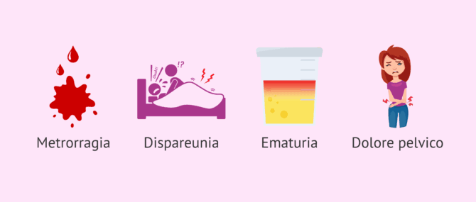 Imagen: Alcuni possibili segni dell'endometriosi