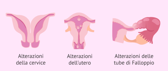 Imagen: Anomalie rilevate dall'HSG
