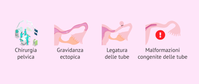 Imagen: Altre cause di fattore tubarico