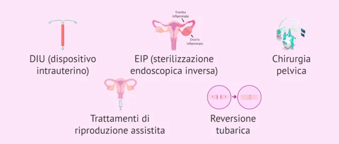 Imagen: Altri fattori di rischio della gravidanza extrauterina