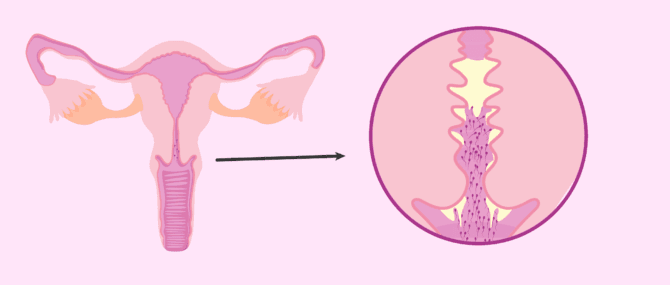 Imagen: Infertilità causata da anticorpi anti-spermatozoi