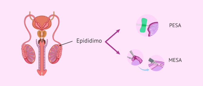 Imagen: PESA e MESA per l'aspirazione di spermatozoi dall'epididimo