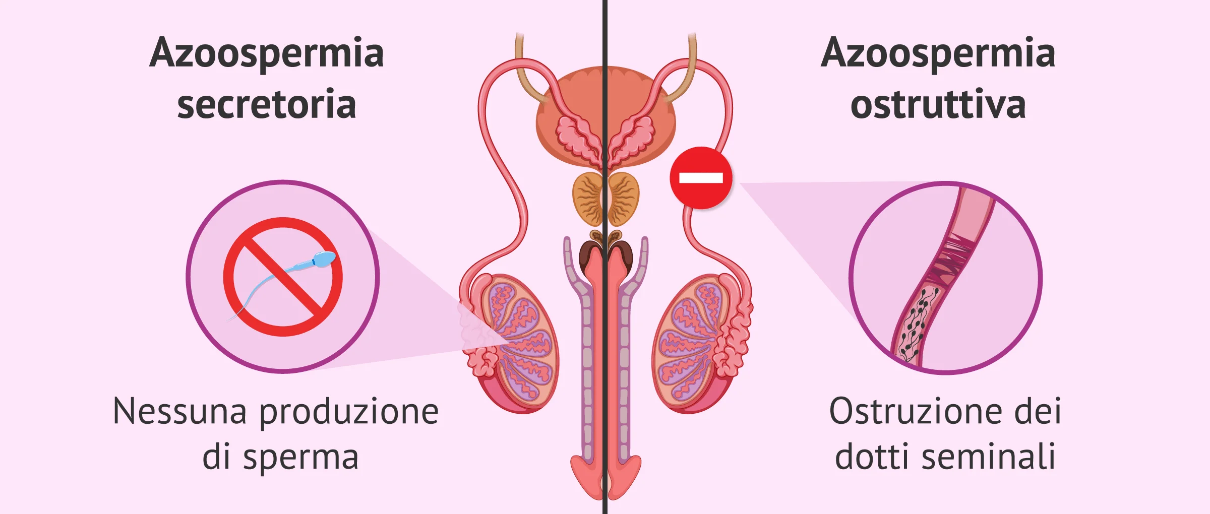 Imagen: Differenza tra i tipi di azoospermia