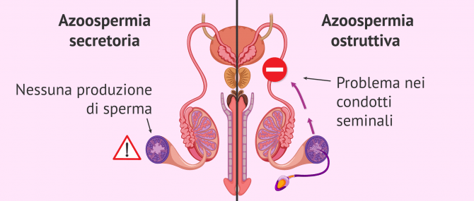 Imagen: Azoospermia ostruttiva immagine