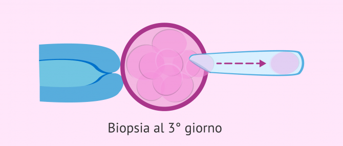 Imagen: Biopsia del blastomero al terzo giorno