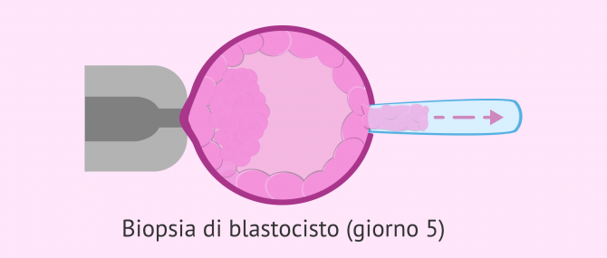 Imagen: Biopsia del trofectoderma al 5° giorno