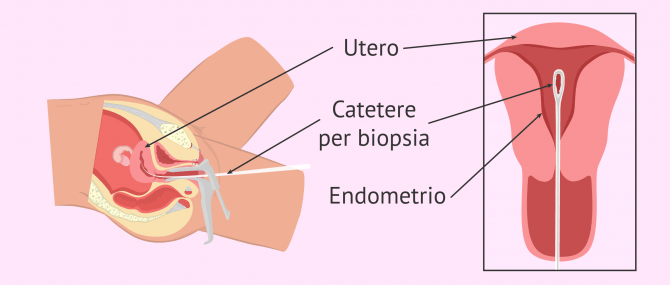 Imagen: Esecuzione della biopsia endometriale