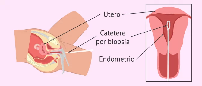 Imagen: Esecuzione della biopsia endometriale