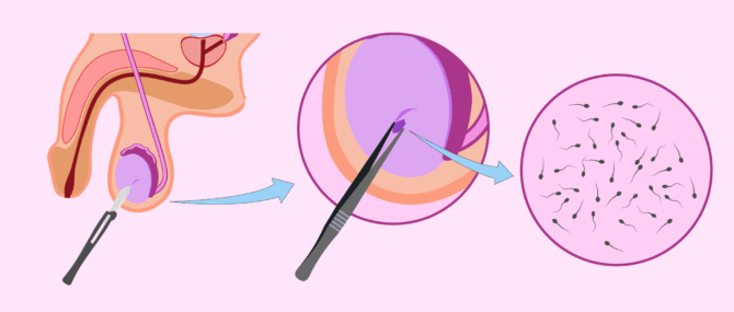 Imagen: Biopsia testicolare