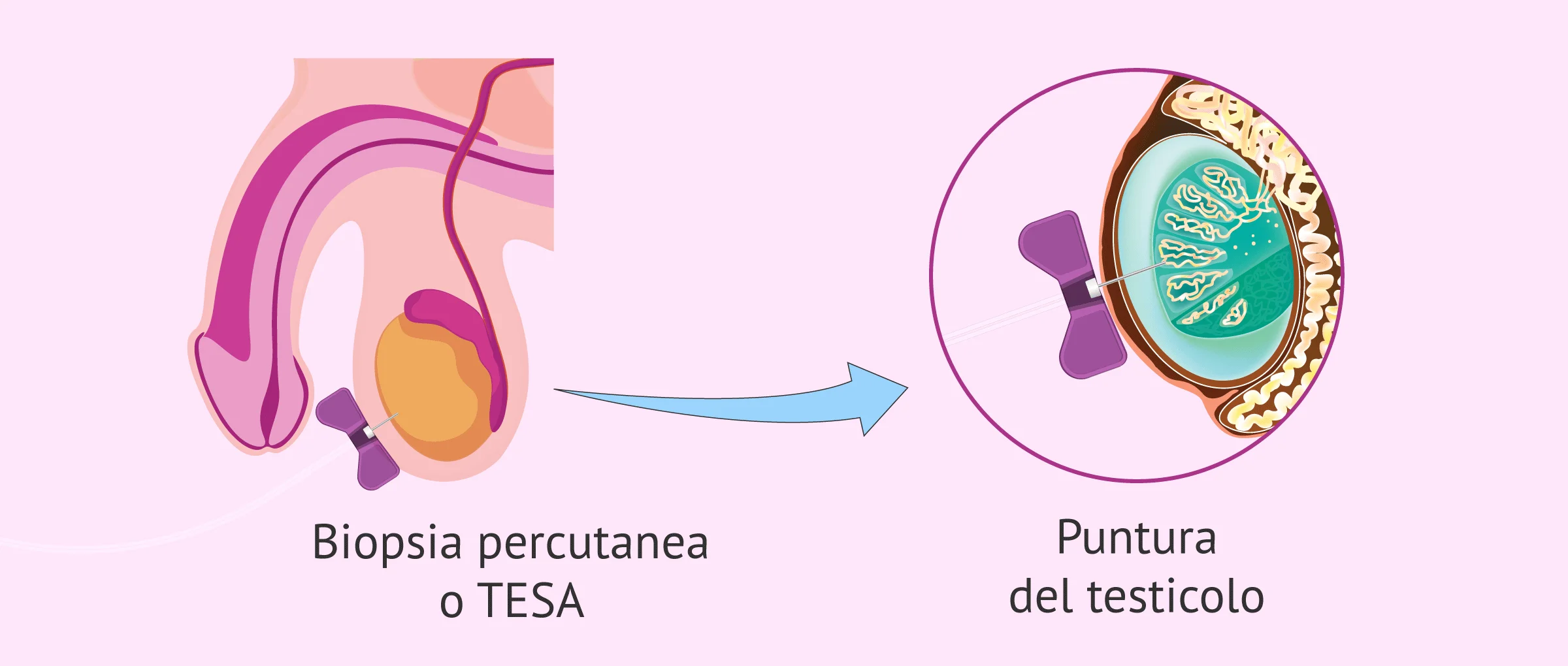 Imagen: Biopsia testicolare percutanea (TESA)