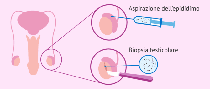 Imagen: ICSI in casi di grave infertilità maschile