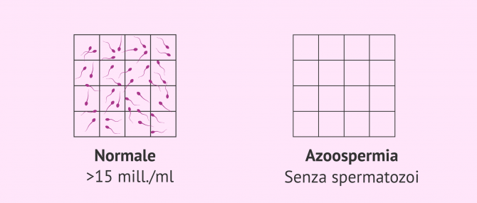 Imagen: Campione di sperma normale e campione seminale con azoospermia