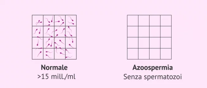 Imagen: Campione di sperma normale e campione seminale con azoospermia