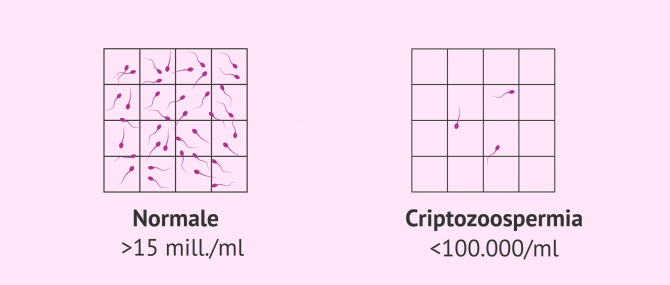 Imagen: Campione di sperma normale e campione con criptozoospermia