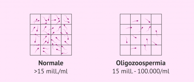 Imagen: Campione di sperma normale e campione oligozoospermico