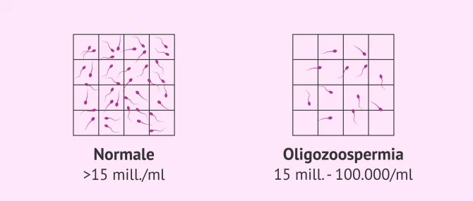 Imagen: Campione di sperma normale e campione oligozoospermico