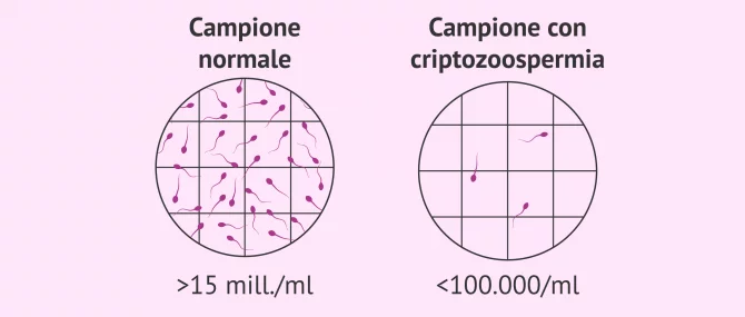 Imagen: Campione di sperma con criptozoospermia