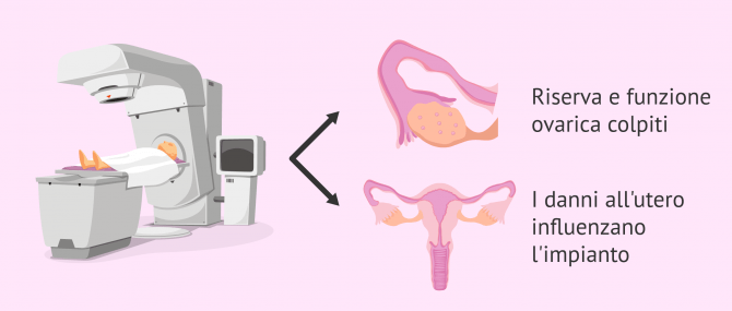 Imagen: Radioterapia e infertilità femminile