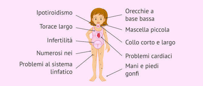 Imagen: Caratteristiche della sindrome di Turner