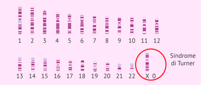 Imagen: Cariotipo della sindrome di Turner