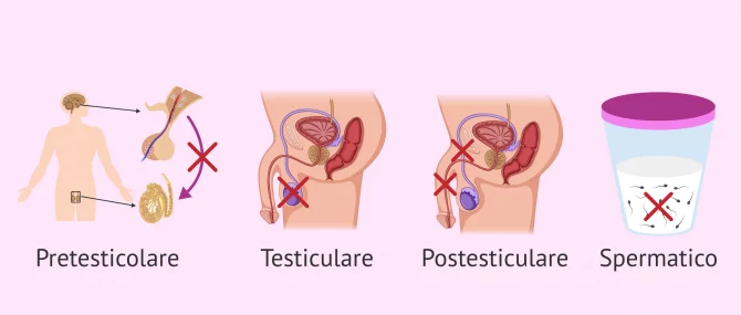 Imagen: Cause della sterilità maschile