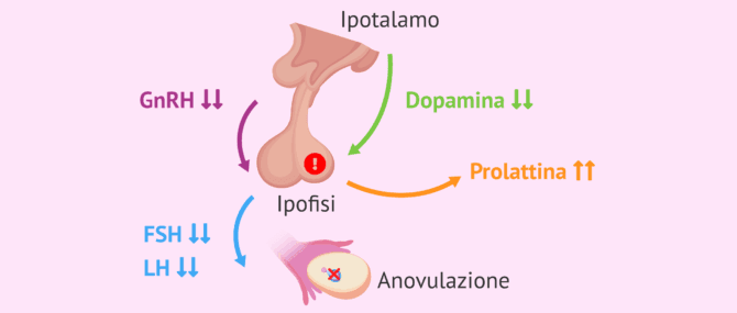 Imagen: Causa più comune dell'iperprolattinemia