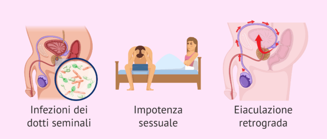 Imagen: Cause di infertilità da fattore post-testicolare