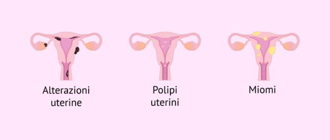 Imagen: Alcune cause endometriali che influenzano l'impianto embrionale