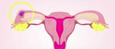 Fattori che causano la gravidanza ectopica