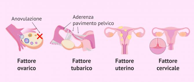 Imagen: L'oligoastenoteratozoospermiae la fecondazione in vitro