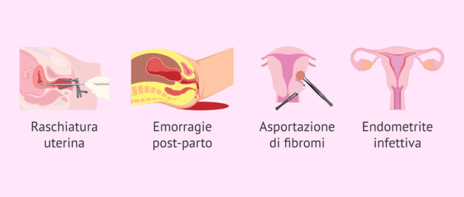 Imagen: Cause delle sinechie uterine