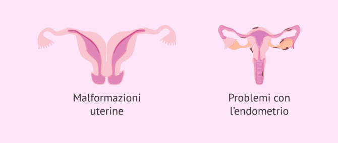 Imagen: Cause uterine di sterilità femminile