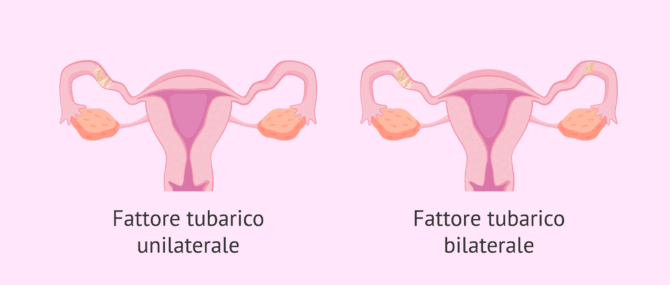 Imagen: Tipi di fattore tubarico