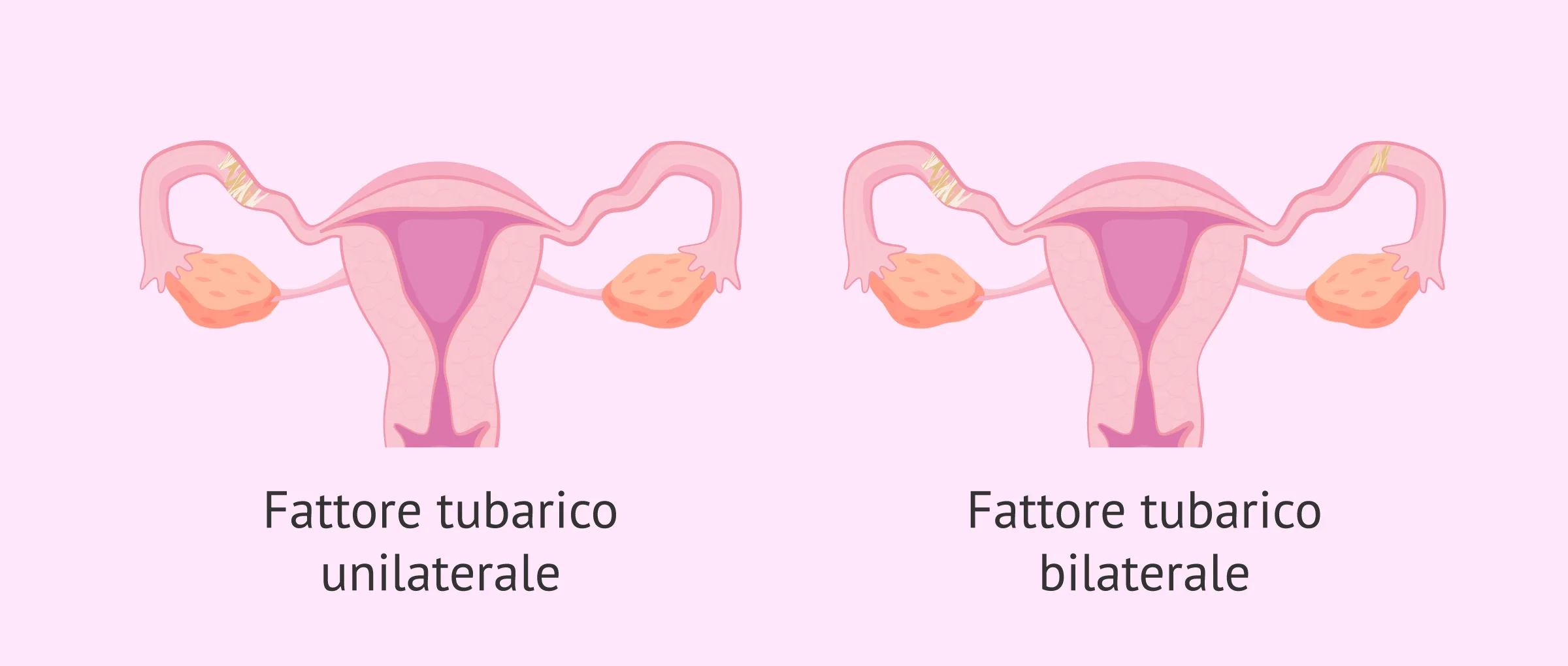 Fattore tubarico