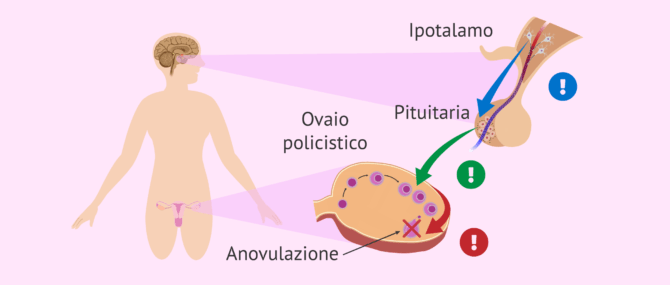 Imagen: Cos'è la sindrome dell'ovaio policistico (PCOS)?
