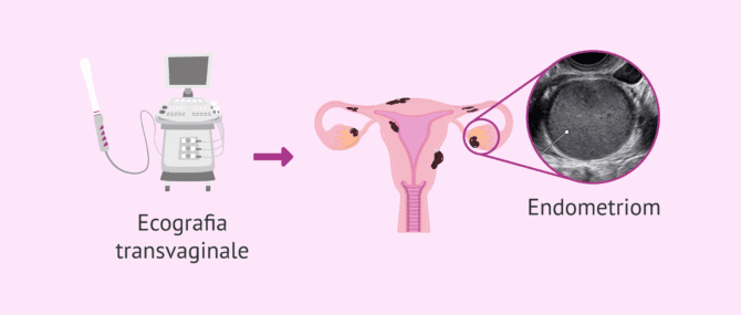 Imagen: Ecografia transvaginale per individuare le cisti al cioccolato